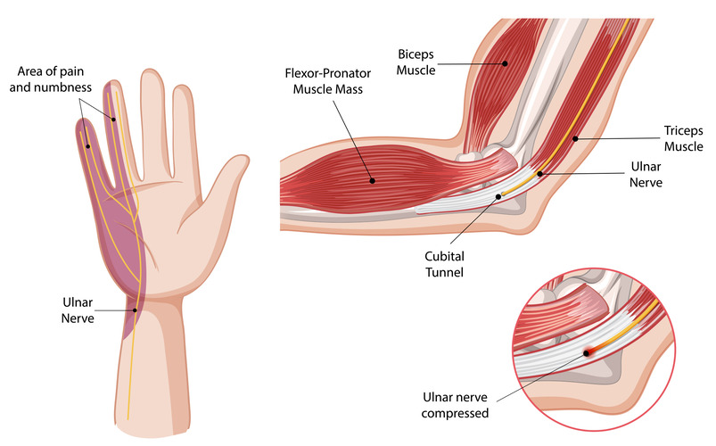 Diagram depicting the elbow and forearm muscles with labels, emphasizing the cubital tunnel structure.