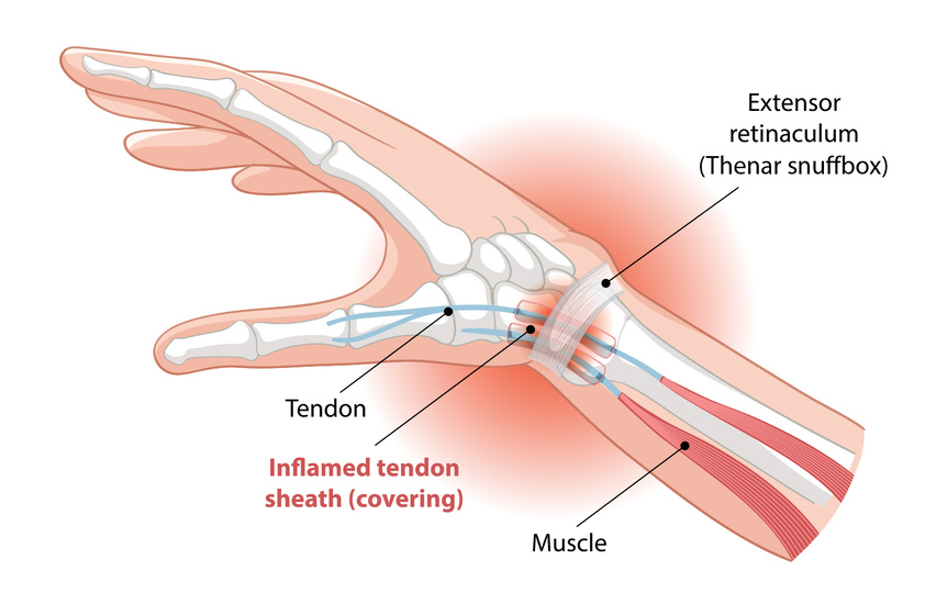 Image illustrating a hand with an inflammed tendon sheath (covering) and thenar snuffbox.