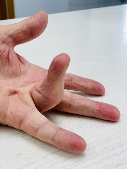 A picture of a hand with Dupuytren’s contracture