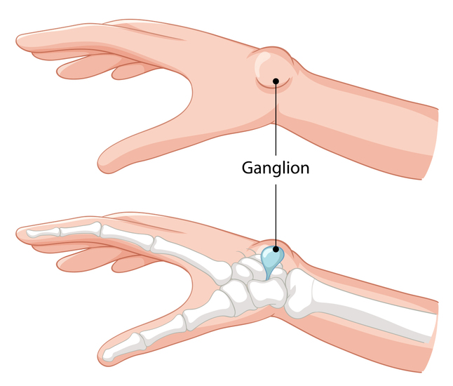 Diagram of a hand and wrist highlighting a bone and a ganglion cyst on the wrist.