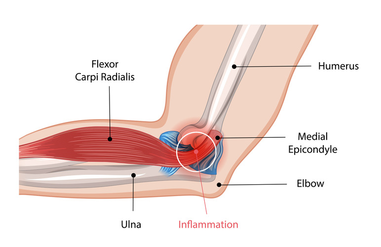 Diagram depicting the muscles of the elbow, showcasing the arm's medical epicondyle. 