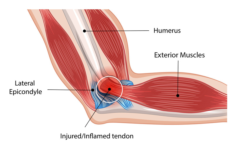 Visual representation of the muscles in the arm and shoulder, including exterior muscles, lateral epicondyle, tendon. Image shows where overuse of the exterior muscles may cause pain.