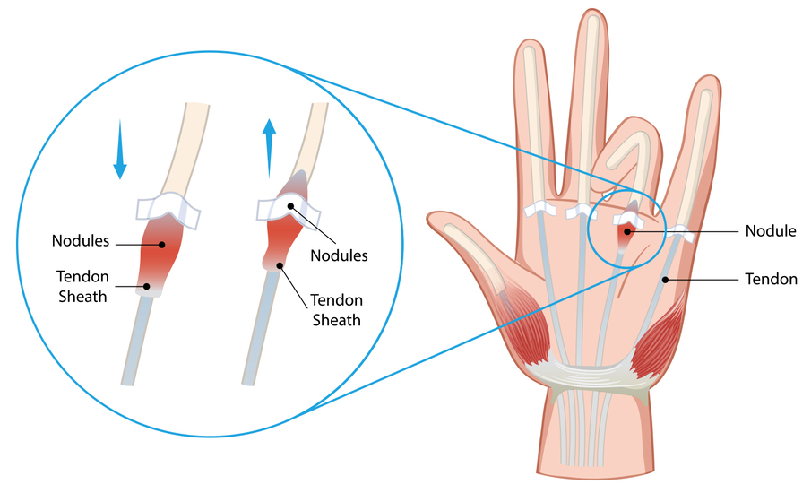 An illustrated hand and a picture of a hand, both with the ring finger tucked in, symbolizing the trigger finger condition and its impact on hand movement.