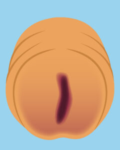 Illustration of a meatal tear