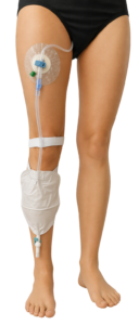 Illustration of the urinary leg bag