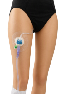 Illustration of catheter fixation with slack